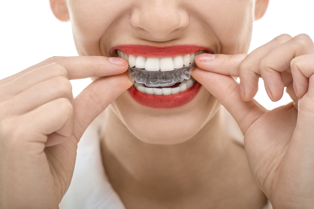 4 Benefits of Invisalign - Silverado Dental Wellness
